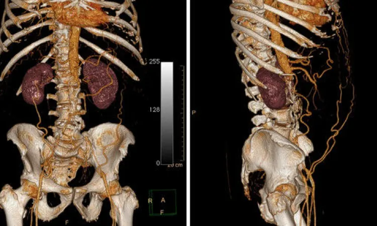 3D-реконструкция КТ органов брюшной полости и малого таза