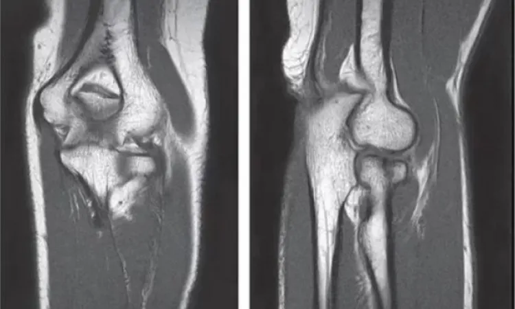 Снимок МРТ локтевого сустава