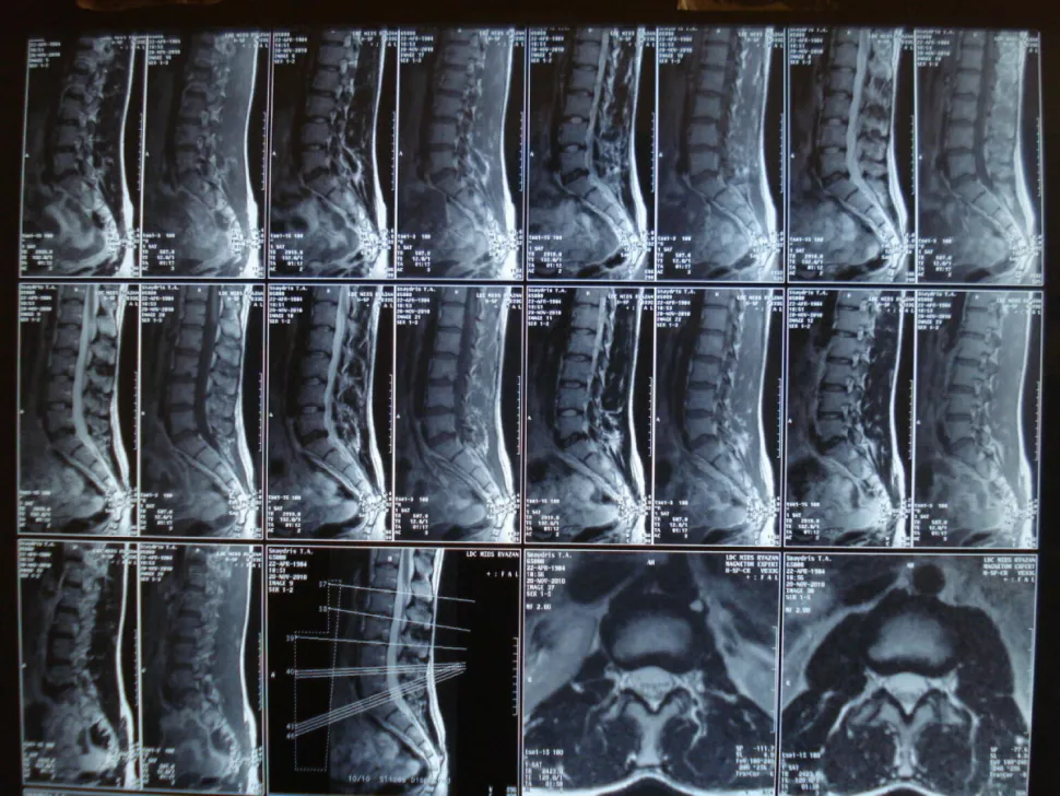 Снимок МРТ пояснично-крестцового отдела позвоночника