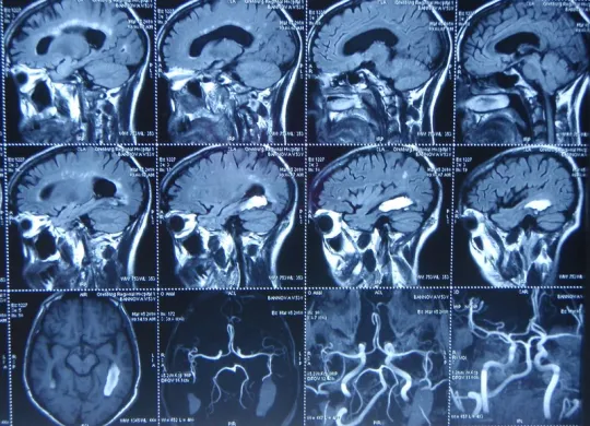 Снимок МРТ мозга