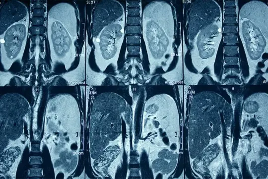 Снимок МРТ органов малого таза