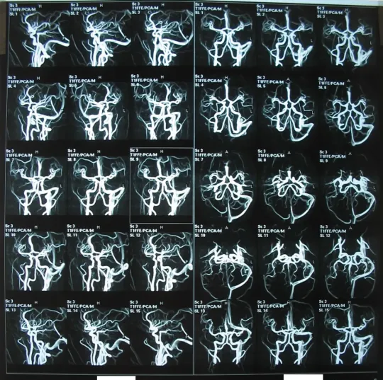 Снимок МРТ сосудов мозга