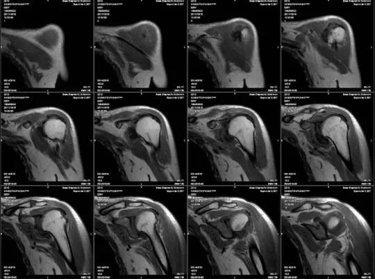 Мрт плечевого. Адгезивный капсулит мрт. Разрыв ротаторной манжеты плечевого сустава мрт. Мрт плечевого сустава, акс. Адгезивный капсулит плечевого сустава мрт.