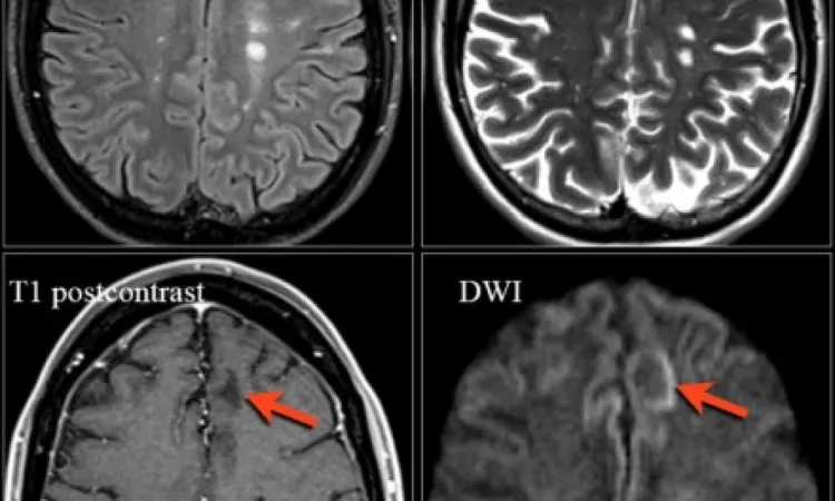 Белые пятна на МРТ мозга
