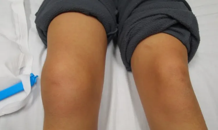 Травма коленной чашечки