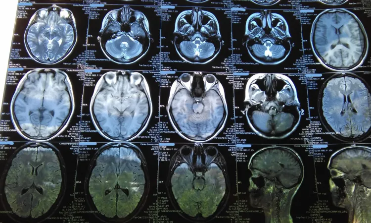 Снимок МРТ головного мозга в САО