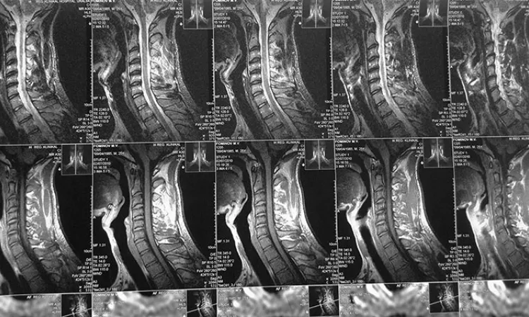 Снимок МРТ шейного отдела позвоночника