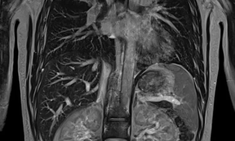 Снимок КТ органов грудной клетки