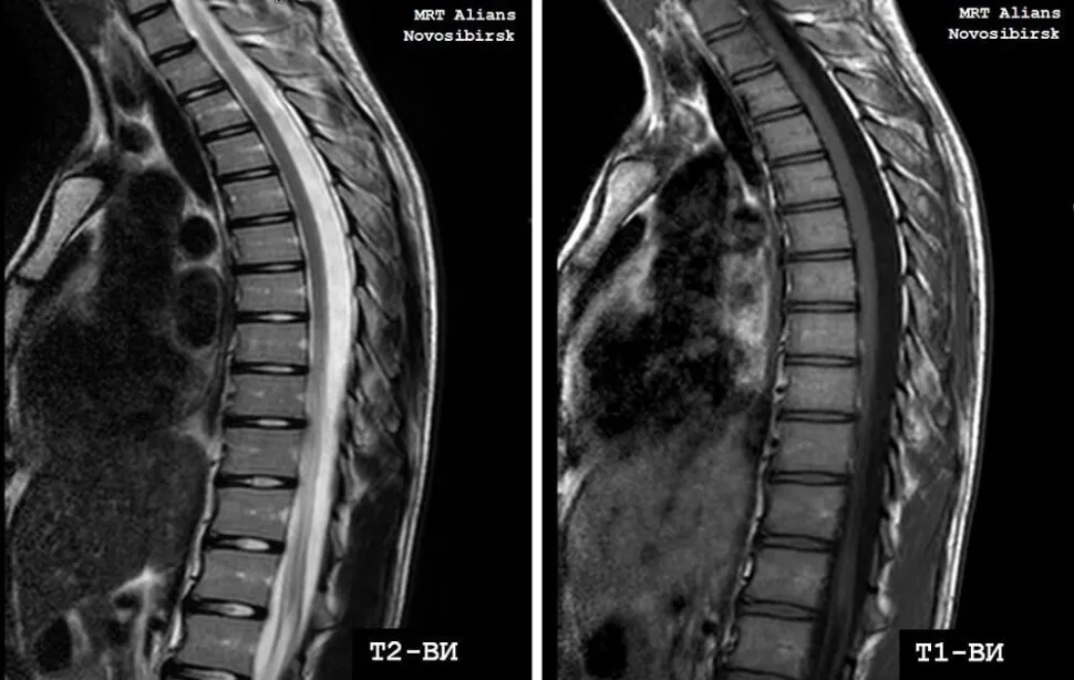 Снимок МРТ грудного отдела позвоночника
