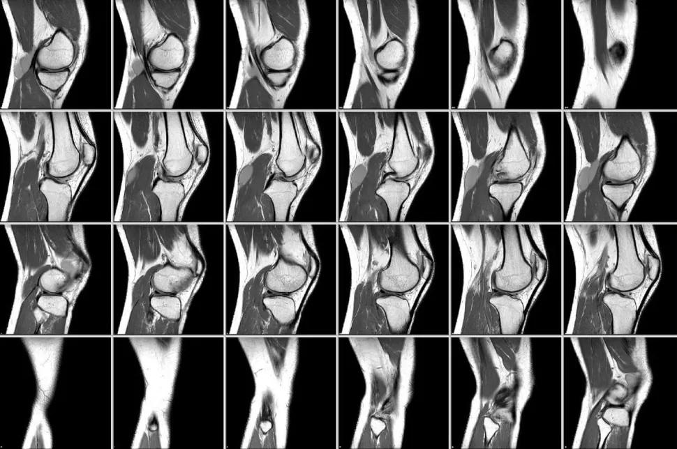 Снимок МРТ локтевого сустава
