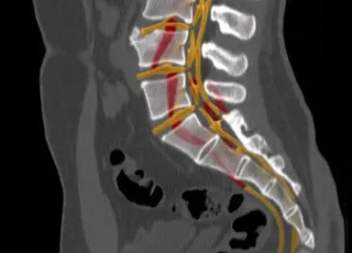 КТ крестцово-копчикового отдела позвоночника