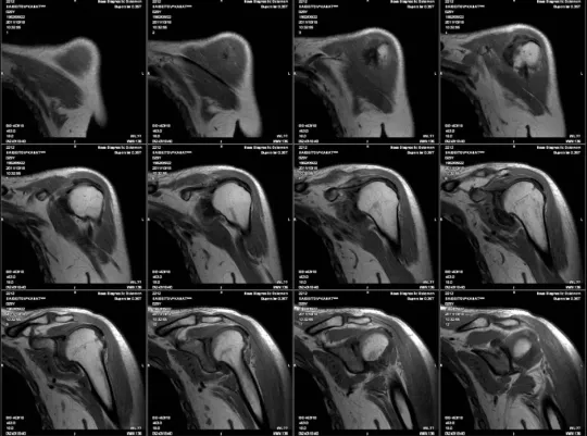 Снимок МРТ плечевого сустава