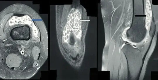Хондроматоз коленного сустава на МРТ