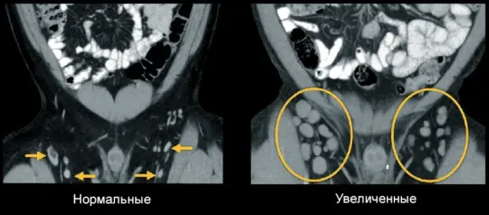 Лимфоузлы на КТ