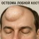 Остеома лобной кости
