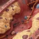 Закупорка кровеносных сосудов