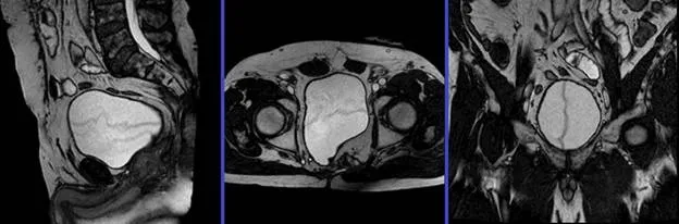 Снимок МРТ мочевого пузыря