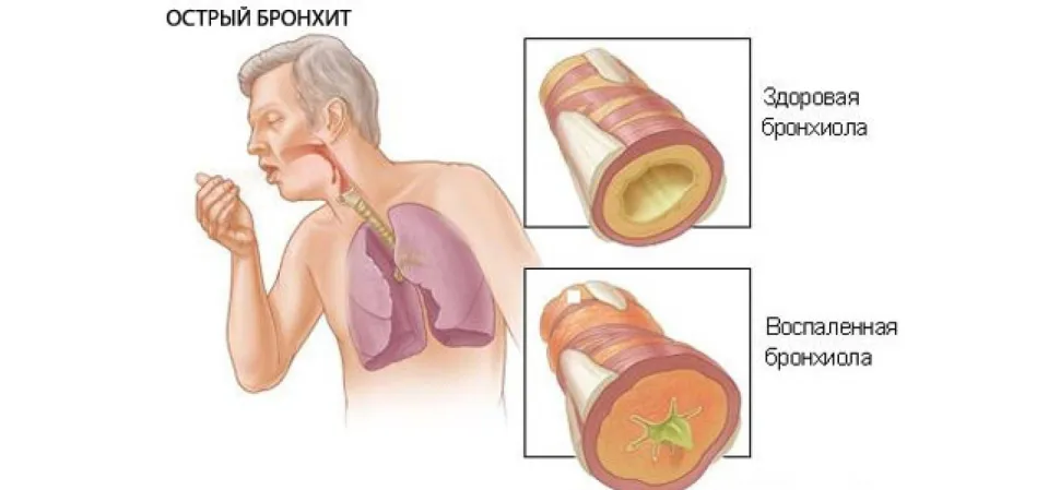 Здоровая и воспаленная бронхиола