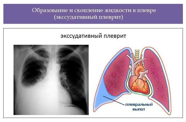 Скопление жидкости в плевре