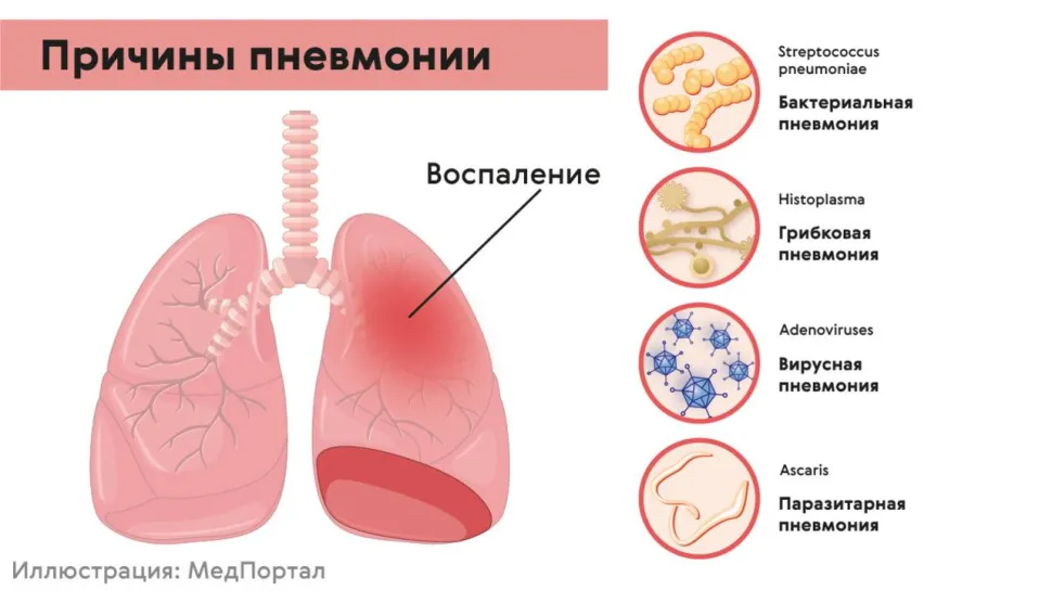 Причины пневмонии