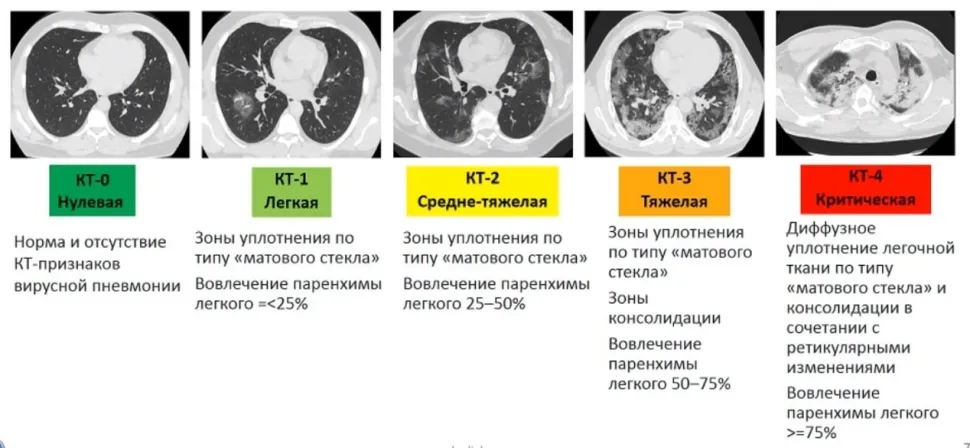 Пневмония на КТ снимке