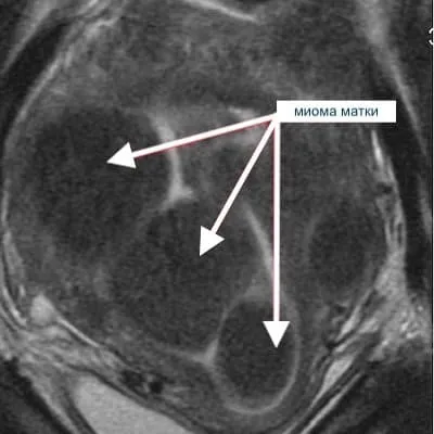 Снимок МРТ миомы матки