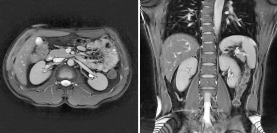 Снимок МРТ почек