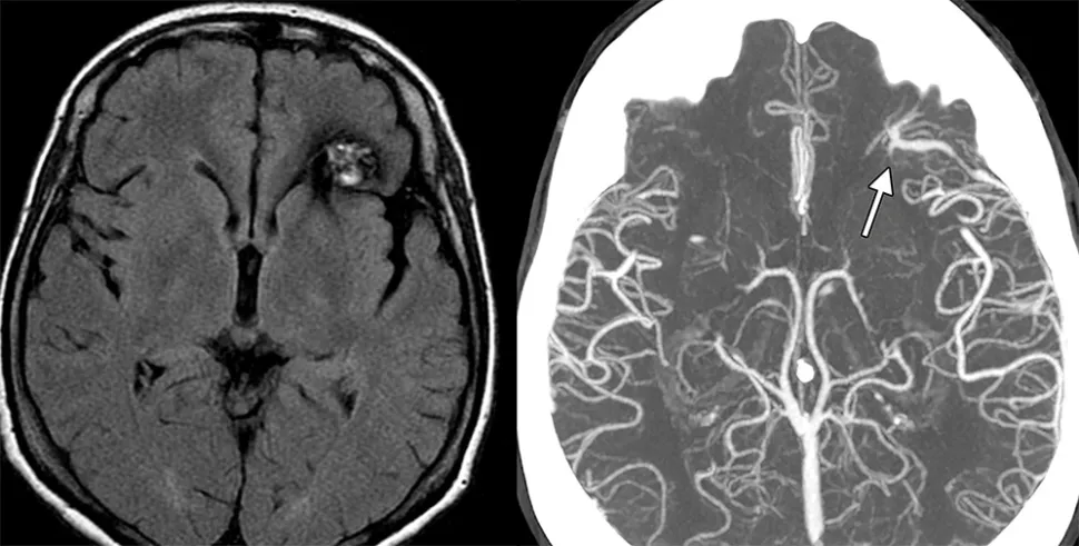 Ангиома мозга на снимке КТ